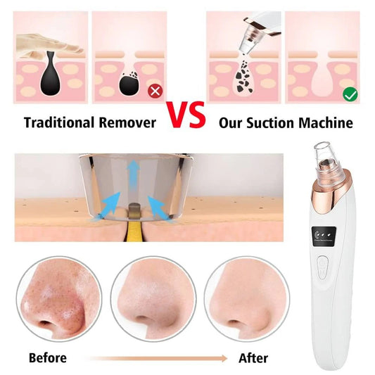 Electric Blackhead Remover | Vacuum Acne &amp; Pore Cleaner